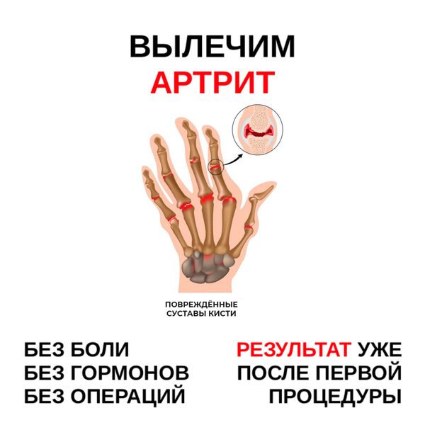 Креативы для суставов, cpa арбитраж трафика